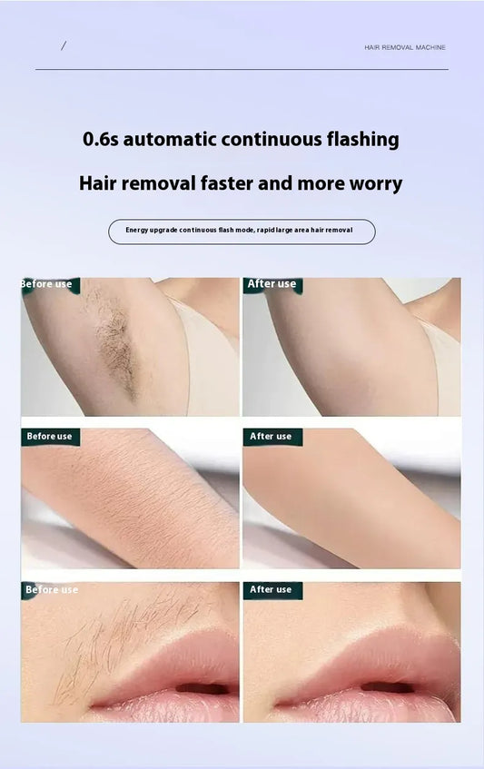 Painless IPL Hair Removal Device – Ice Cooling Technology™ | Safe & Effective At-Home Laser