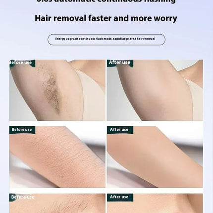 Painless IPL Hair Removal Device – Ice Cooling Technology™